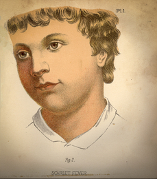 An illustration of a child with scarlet fever taken from a "Warren's Household Physician" book of 1885